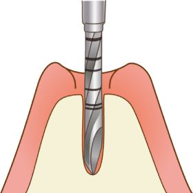 インプラント手術（1次）