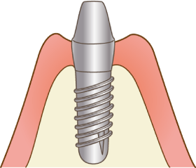 インプラント手術（2次）