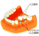 インプラント