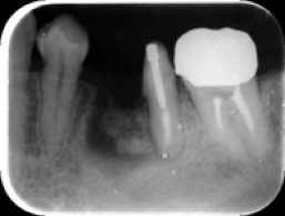 骨補填（x-ray写真）手術後
