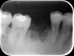 骨補填（x-ray写真）手術後