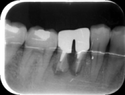 骨補填（x-ray写真）手術前