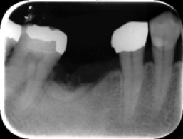 骨補填（x-ray写真）手術後