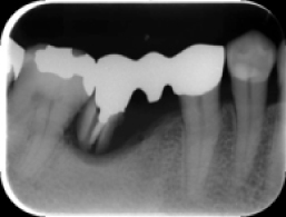 骨補填（x-ray写真）手術前