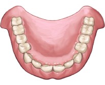 総入れ歯