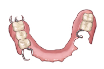 部分入れ歯