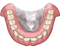 総入れ歯