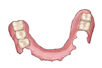 部分入れ歯